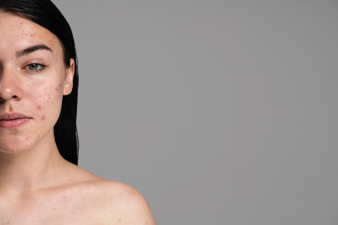 Zioła na trądzik – naturalne i skuteczne sposoby na walkę z niedoskonałościami skóry